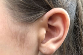 【耳瘻孔（じろうこう）】100人に1人！耳の上の小さな穴、みたことありますか？
