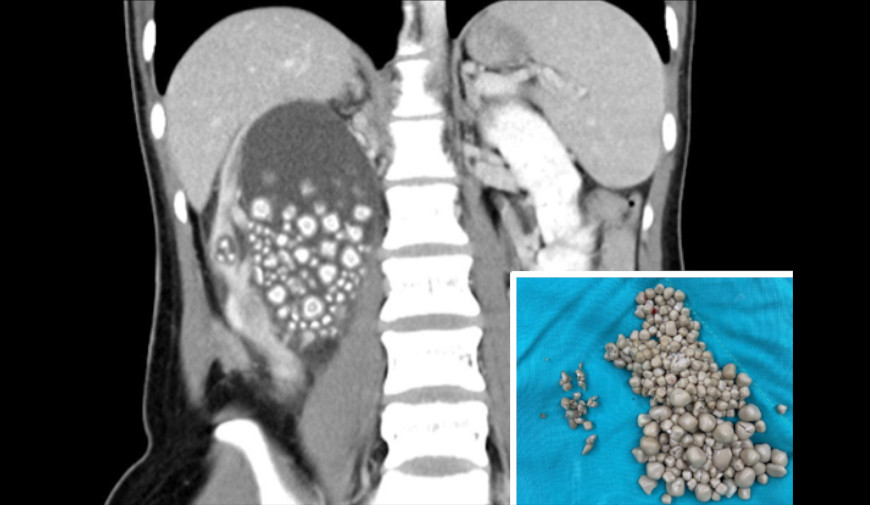 水の代わりにタピオカミルクティーばかり飲んでいた台湾人女性の腎臓から結石が300個以上摘出される！ edamame.